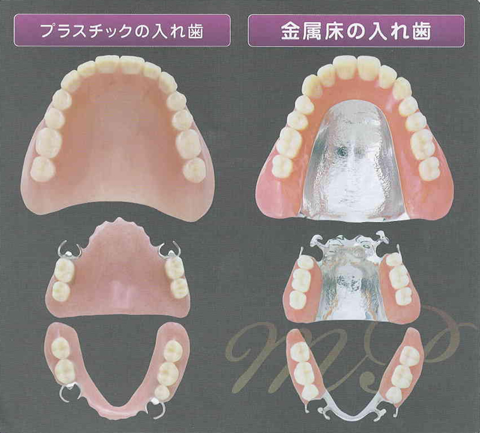 金属床とプラスチックの入れ歯の違い