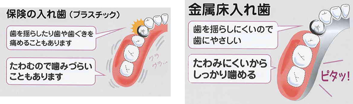 骨格部分が金属なので、たわみにくくしっかり噛める！