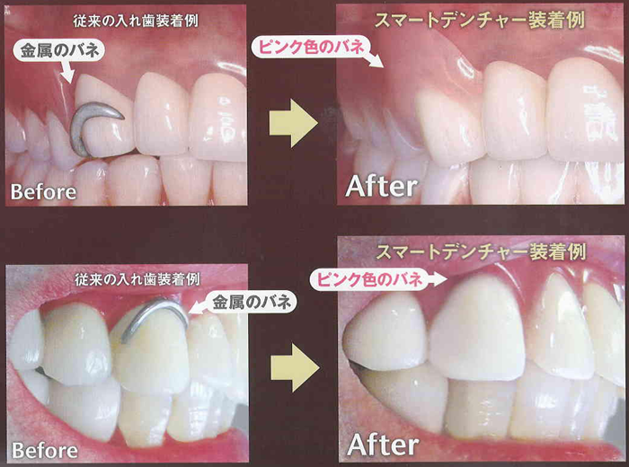 金属の留め金がない入れ歯(ノンクラスプデンチャー)